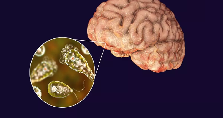 केरल में ‘दिमाग खाने वाले अमीबा’ का कहर, अब तक 61 मामले और 19 मौतें दर्ज