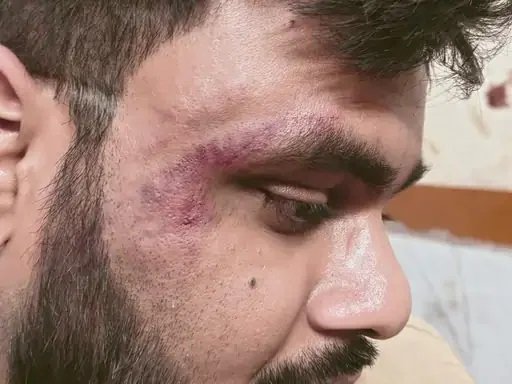 कोरबा में स्वास्थ्य शिविर से लौट रहे डॉक्टर पर हमला, पुलिस ने दर्ज किया मामला