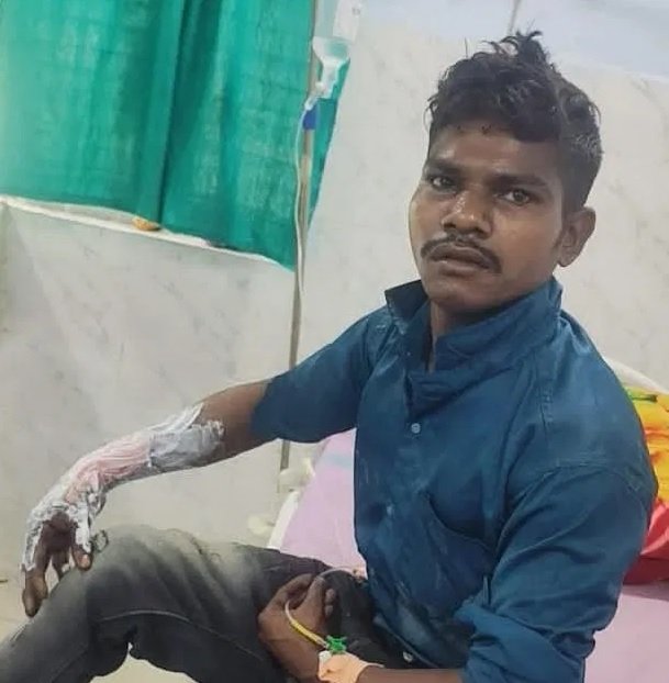 कोरबा: पत्नी पर टिप्पणी से भड़का युवक, दोस्त पर पेट्रोल डालकर लगाई आग; दोनों झुलसे